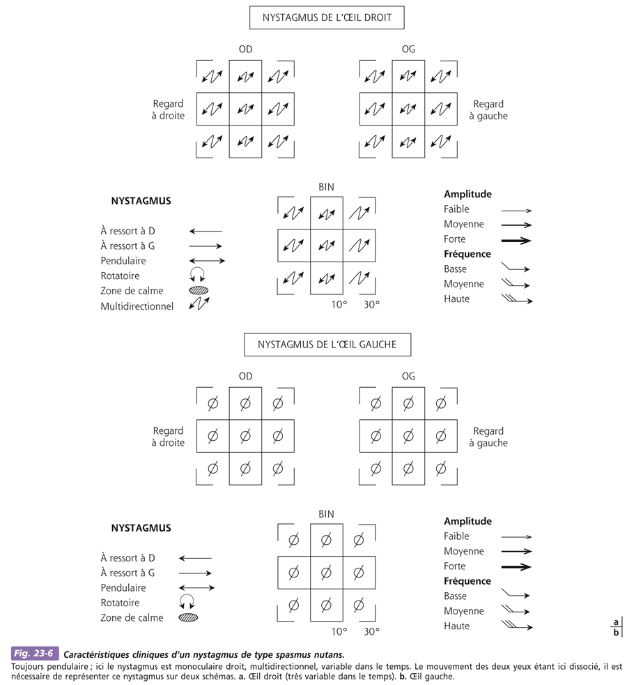 Nystagmus et autres mouvements anormaux