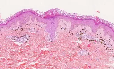 Aspect histopathologique d'un érythème pigmenté fixe du gland