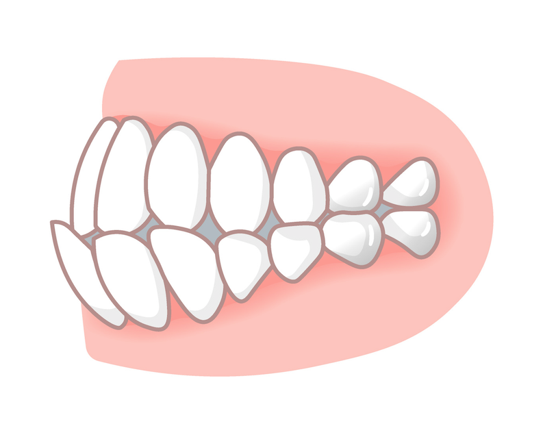 「矯正方法の違いって？」歯並びの悩みごとに原因と適した矯正方法を説明 | ハーウェル 矯正歯科の総合サイト