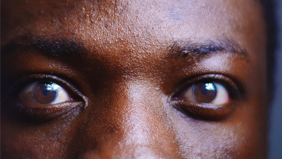 Close-up photo of a person's eyes, showing eye-disease symptoms.