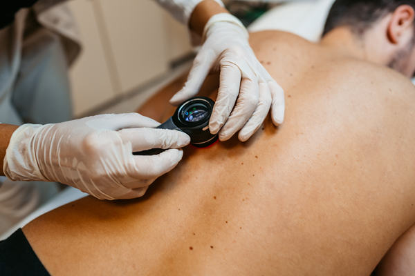 Dermatologist checking freckles on man's back 