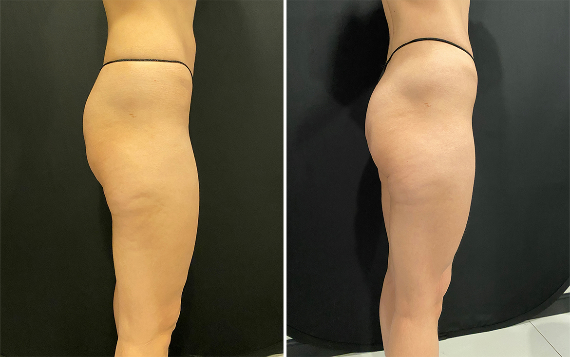 I Tried truSculpt Flex+ For A Non-Surgical Butt Lift – Here Are