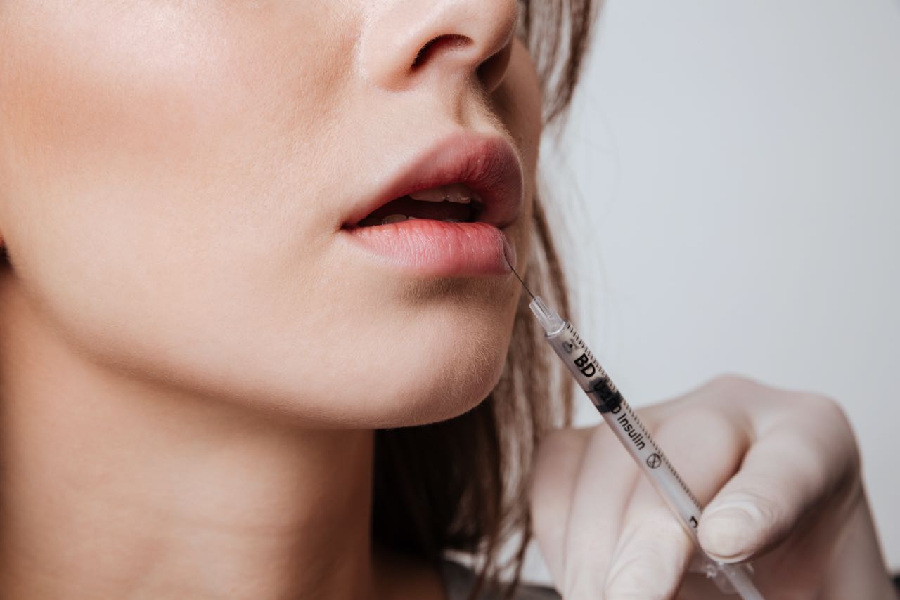 Lip filler: 10 things I wish I'd Known Before My Appointment