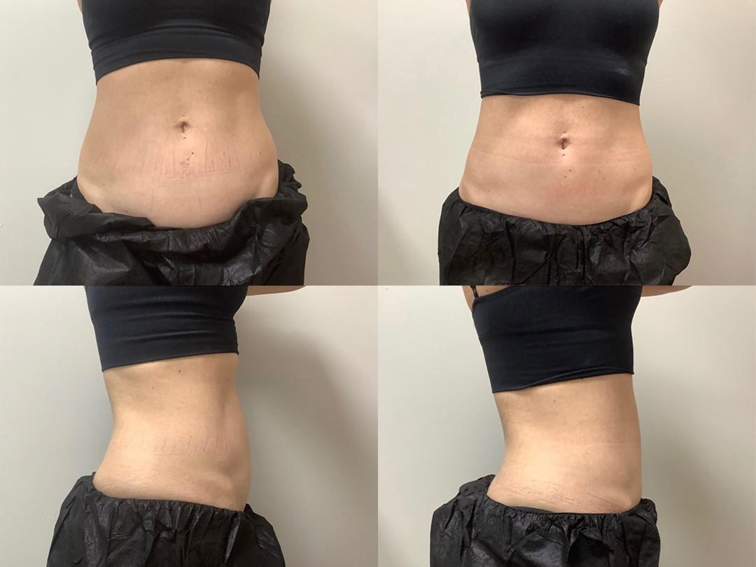 Coolsculpting Before and After Results From Actual Patients