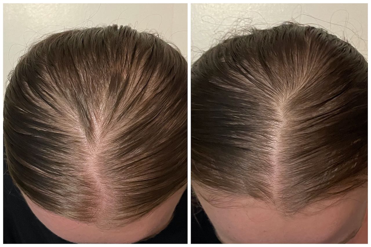 I Tried Minoxidil To Regrow My Hair And This Is What I Look Like Now | The  AEDITION