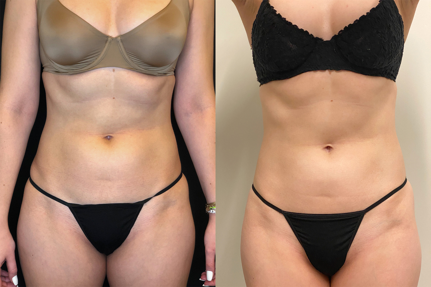 I Tried Emsculpt Neo — Here's My Before And After