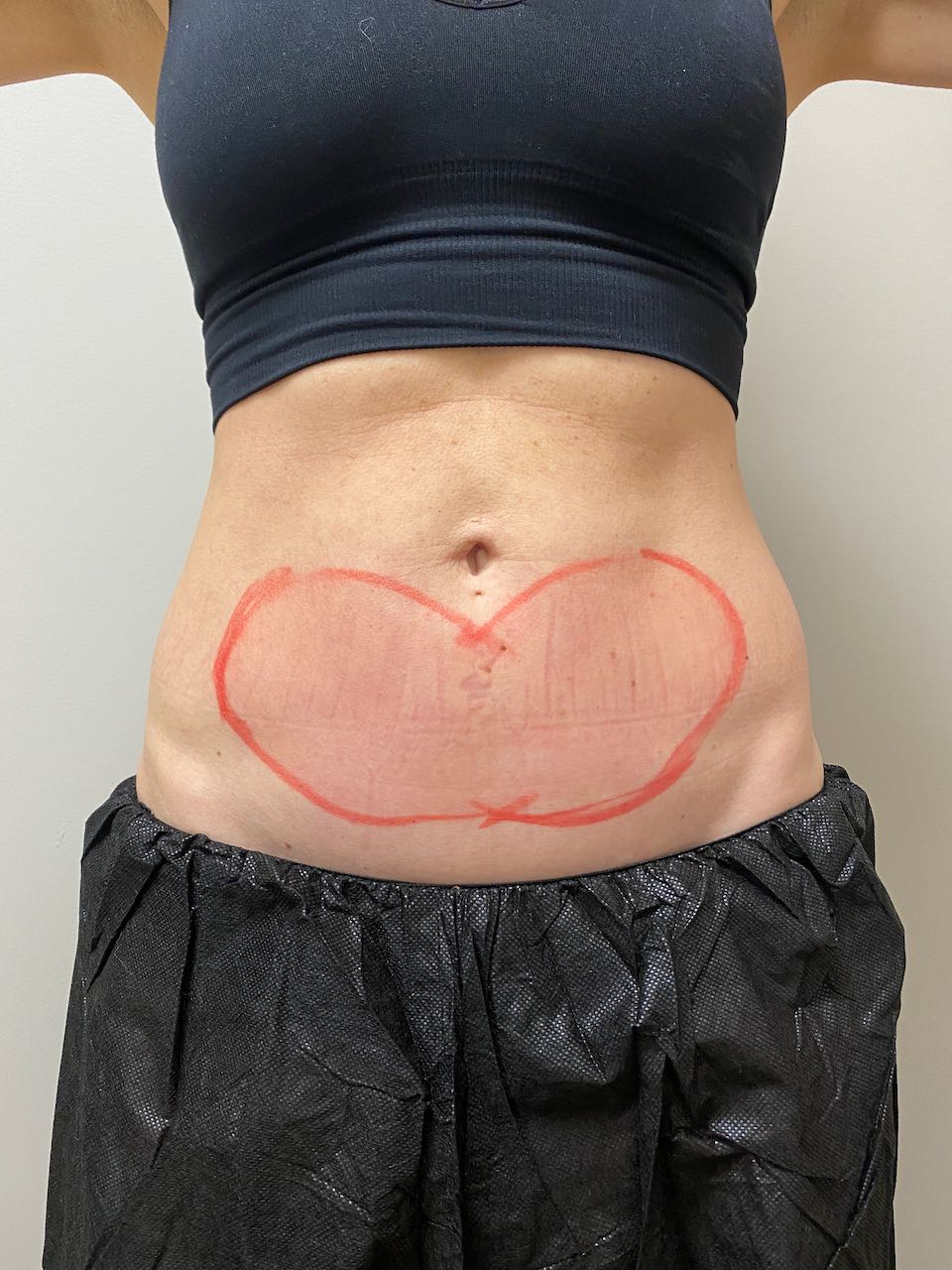 CoolSculpting®, Before & After Photos
