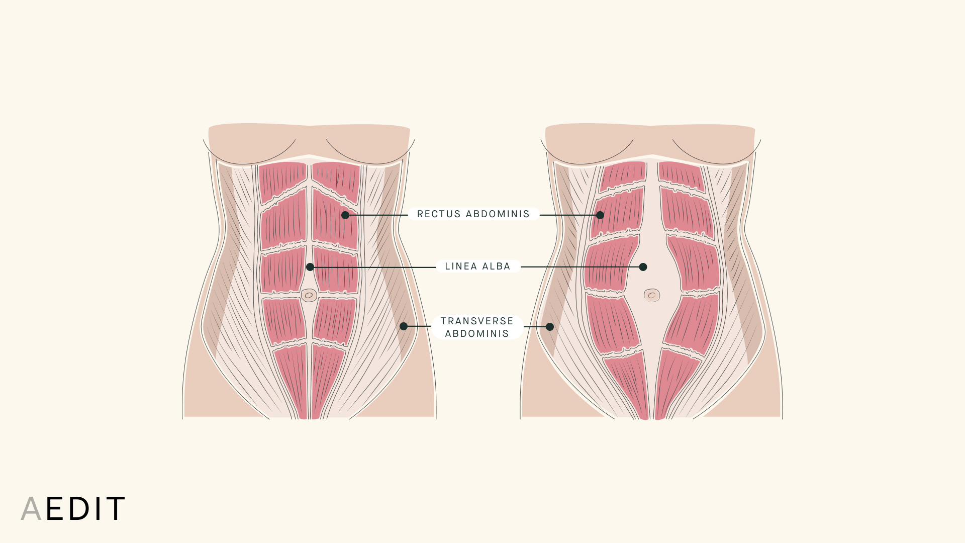 Diastasis Recti Repair Overview: Cost, Recovery, Before & After