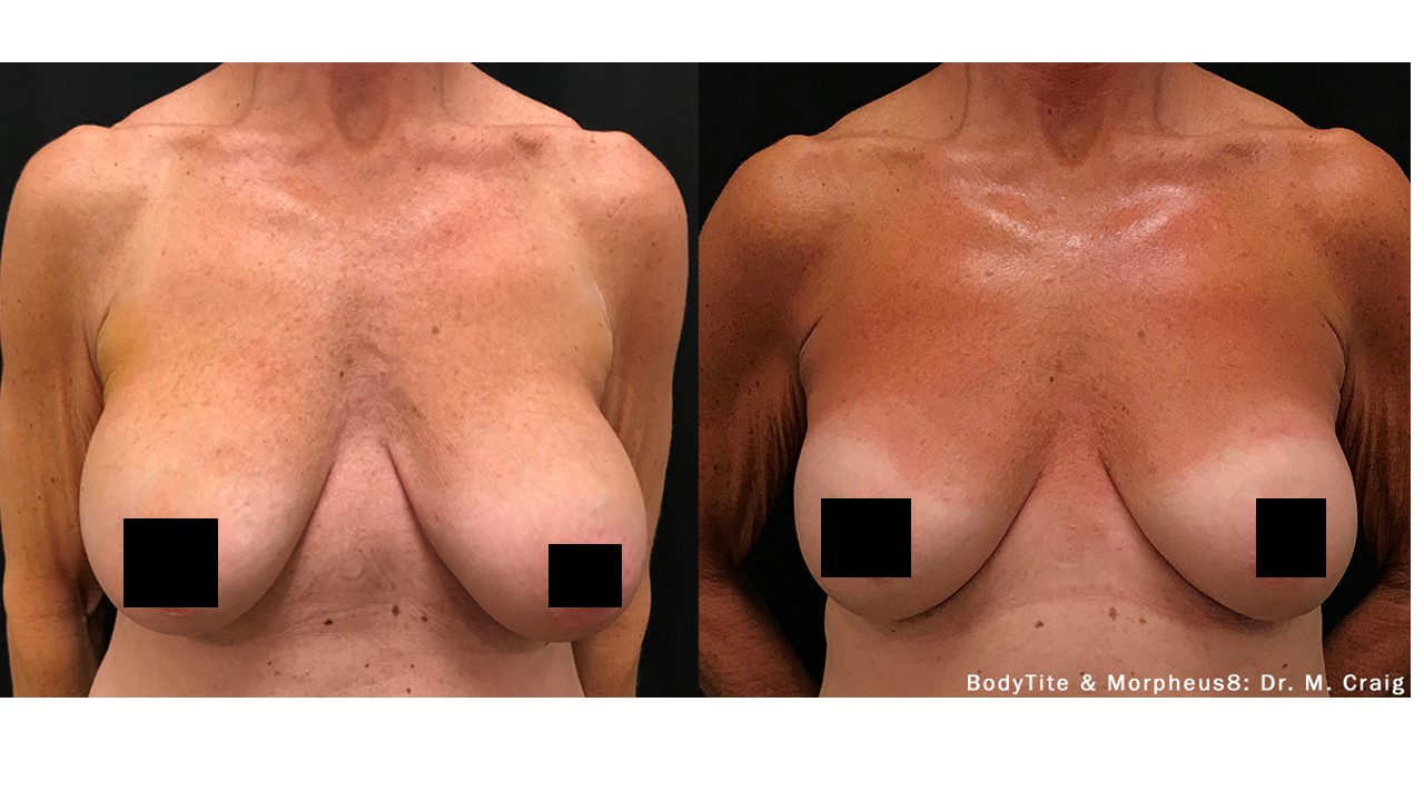 Is This New Breast-Lifting Procedure Right For You? | The AEDITION