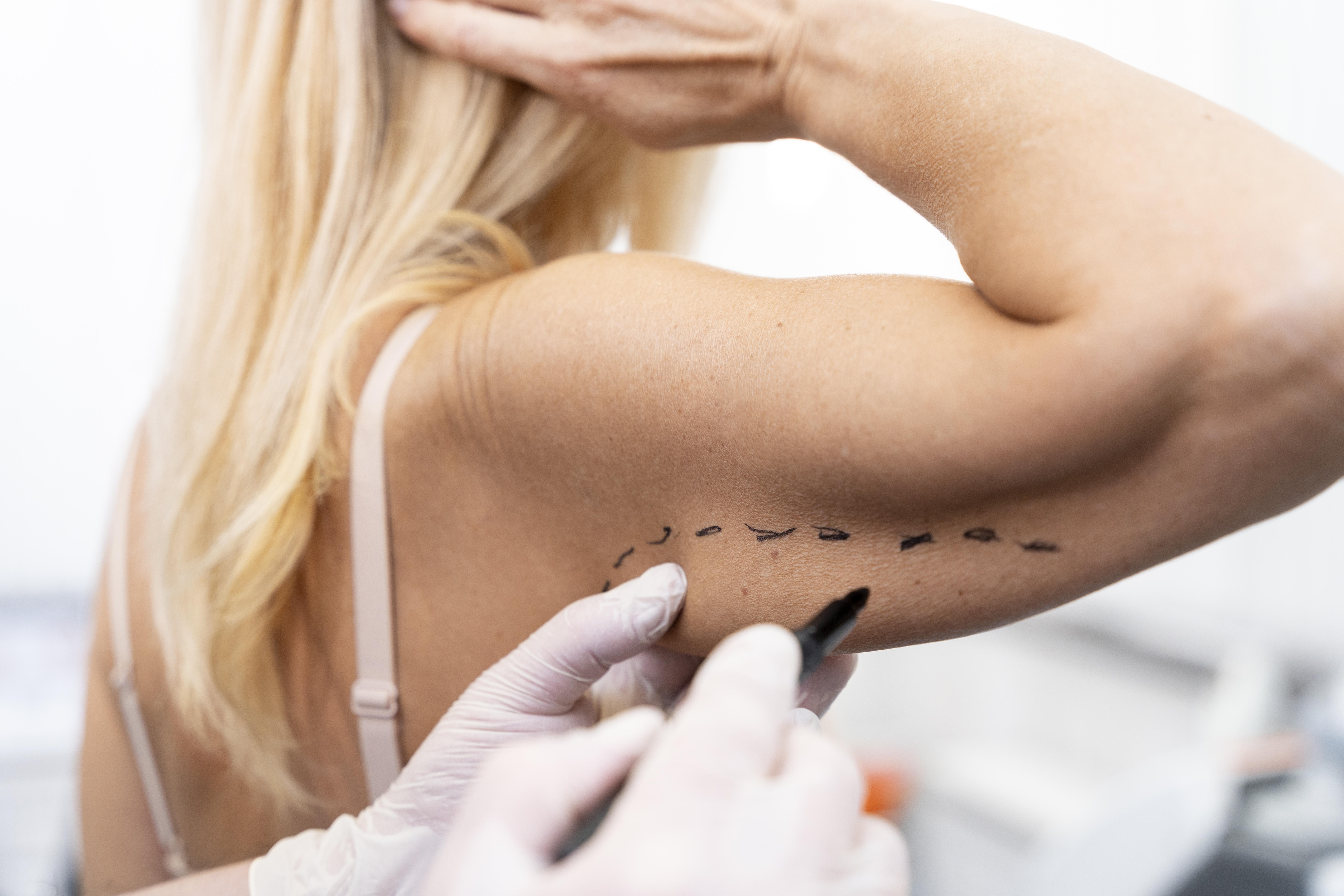 Imagen destacada del post Braquioplastía: el "lifting" de brazos para combatir la flacidez