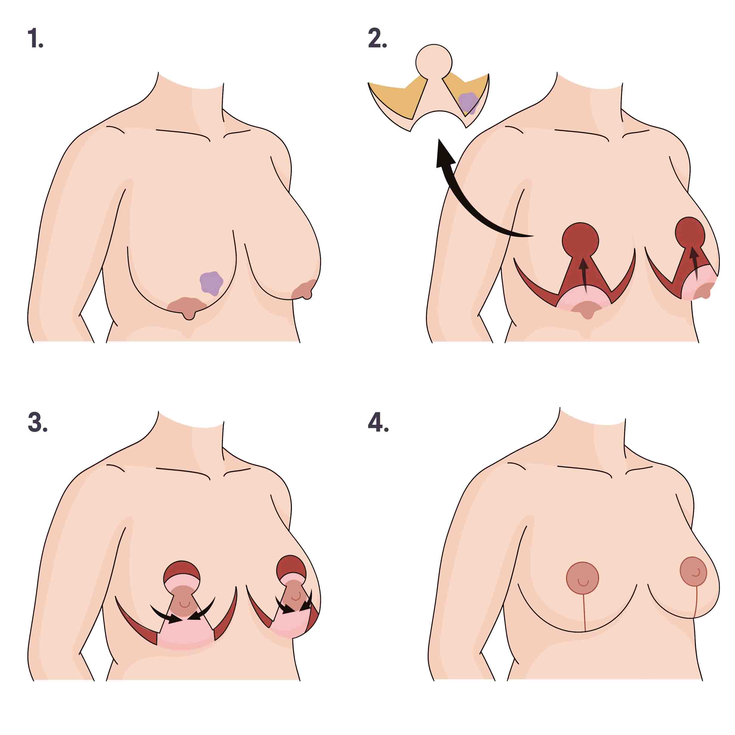 Oncoplastic Reconstruction Image file