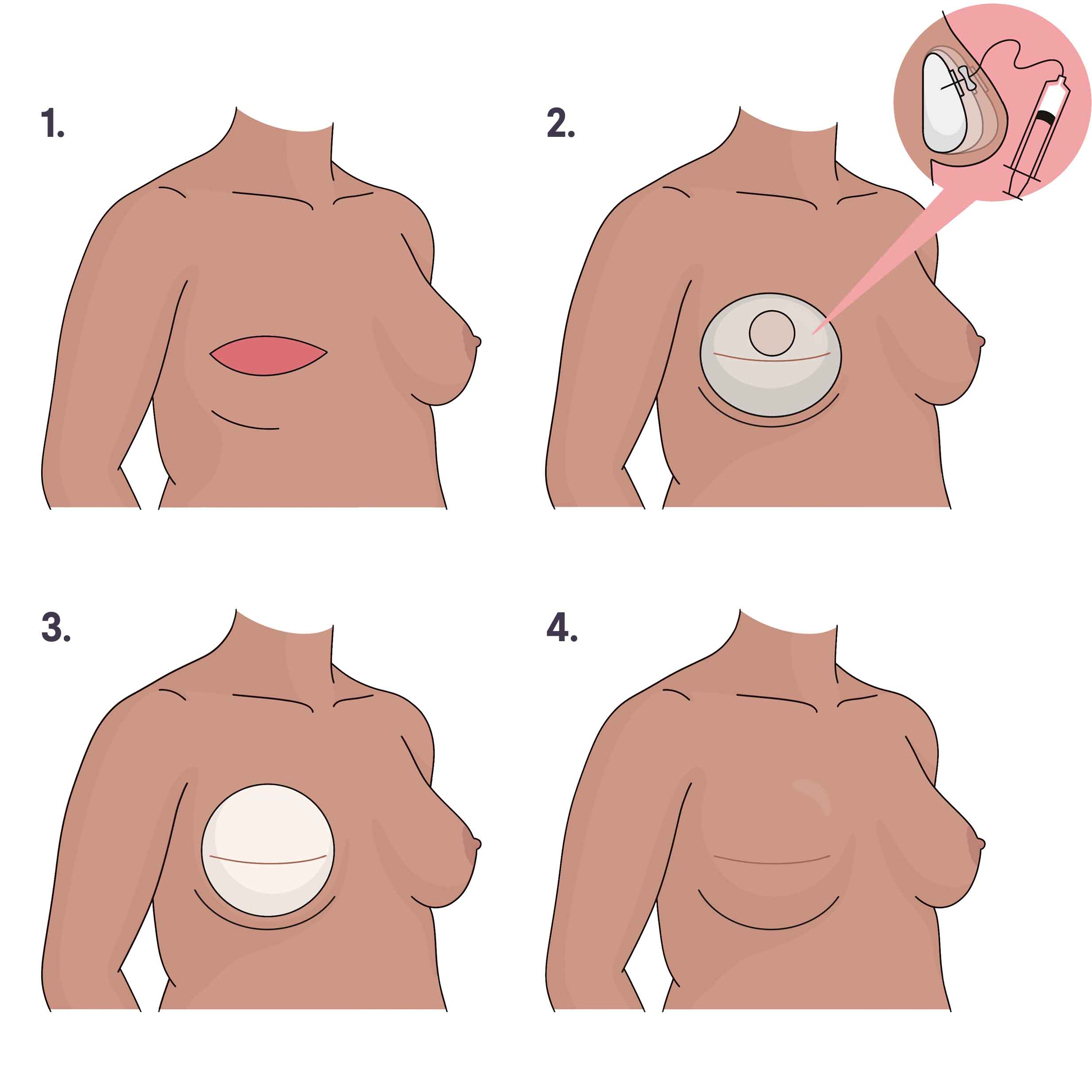 Implant reconstruction image file