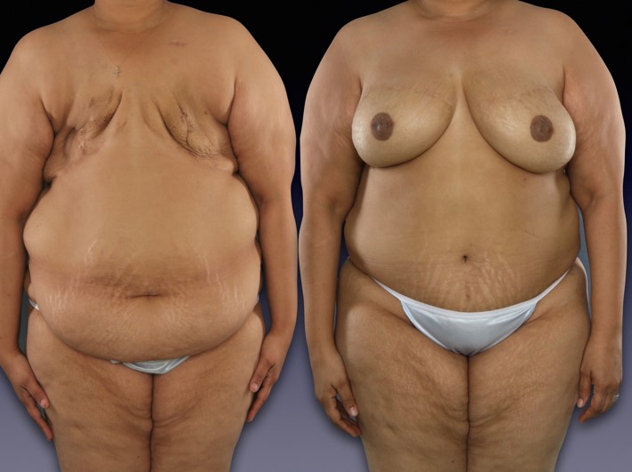 Before and after picture of bilateral delayed DIEP flap reconstruction.