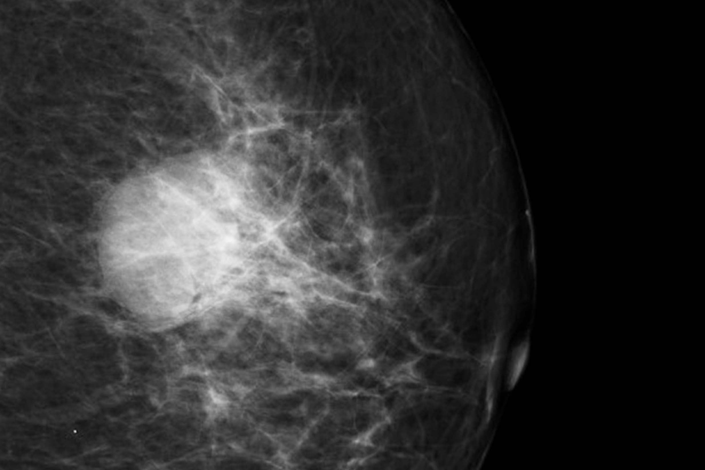 A radigraphic image of a breast cancer tumor on a mammogram.