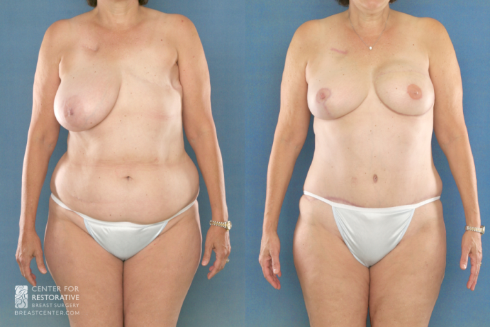 History left breast cancer post-mastectomy. Before and after DIEP flap reconstruction left breast with right breast reduction to C-cup size for symmetry.