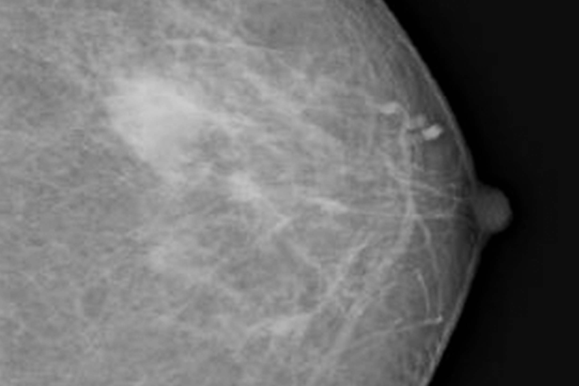 A radiographic image of a breast cyst on a mammogram.