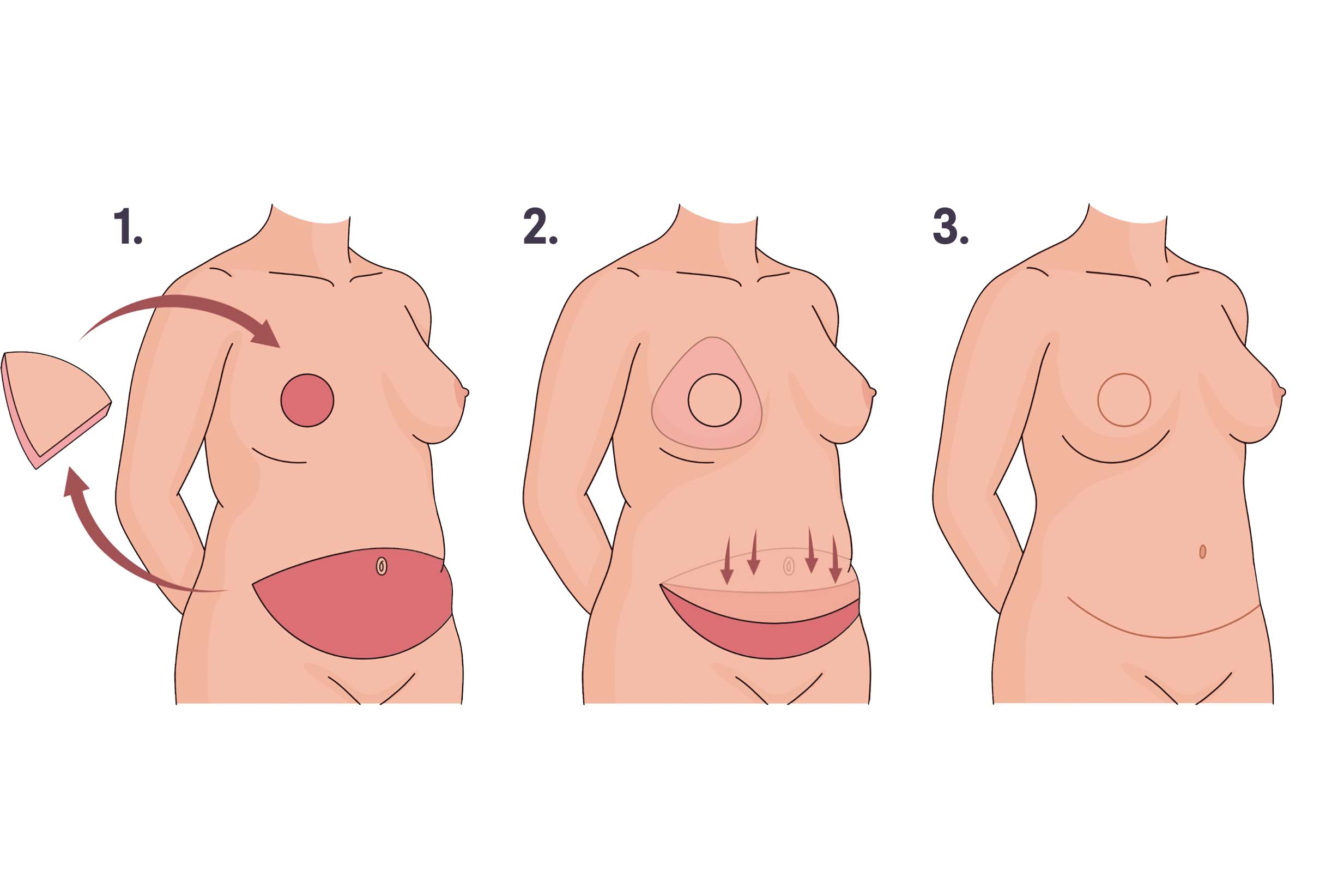 DIEP Flap image file