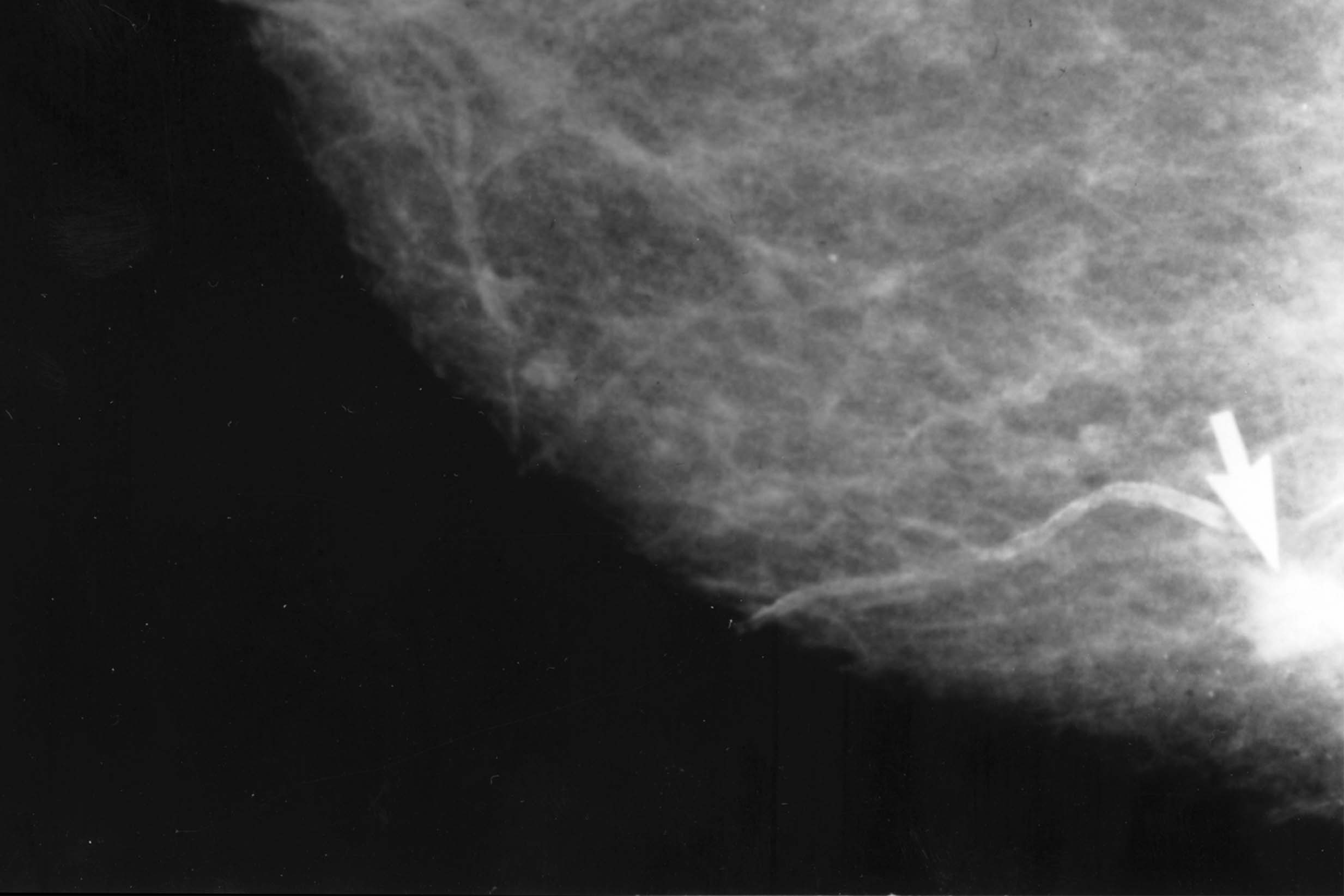 An image of an abnormal mammogram with a cancerous breast tumor.