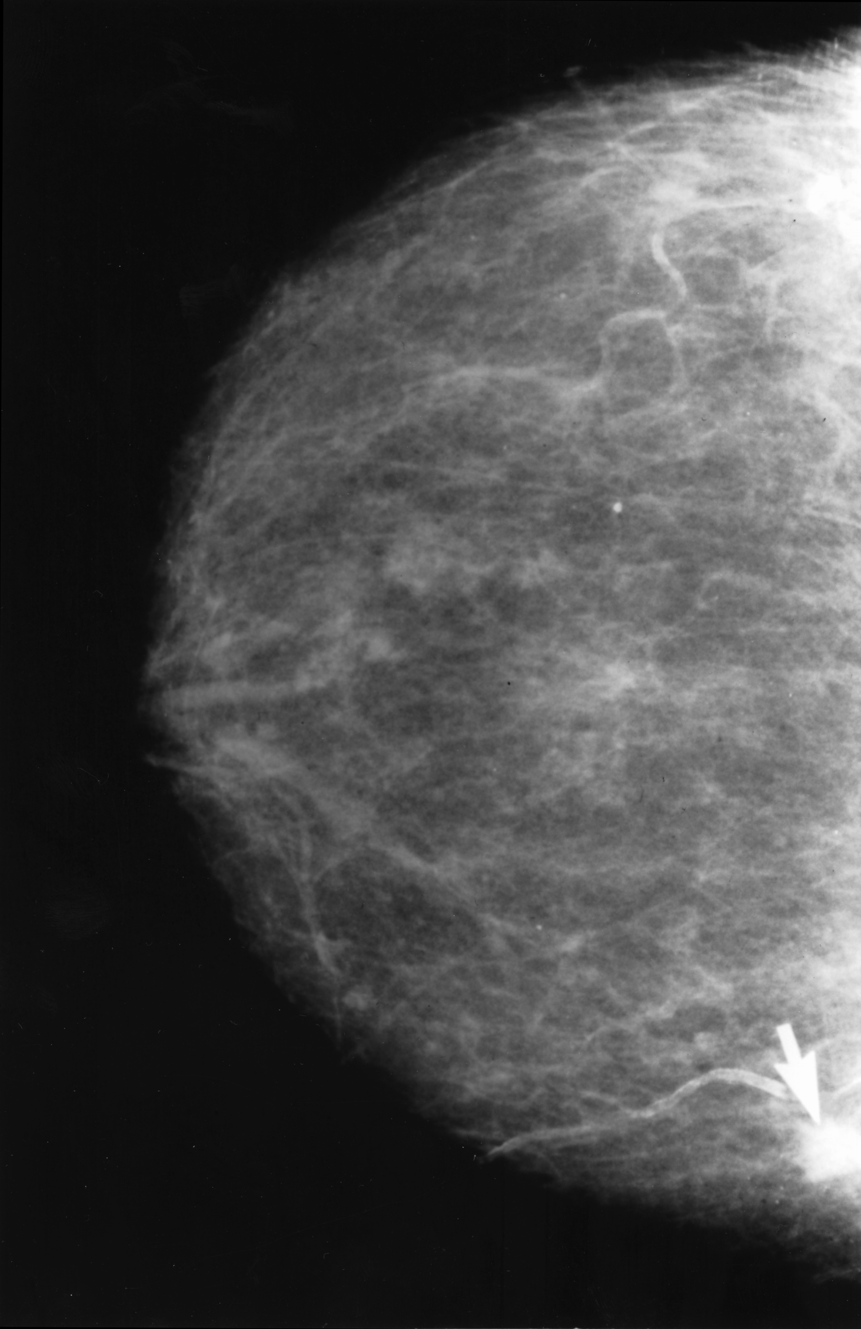 An image of an abnormal mammogram with a cancerous breast tumor.
