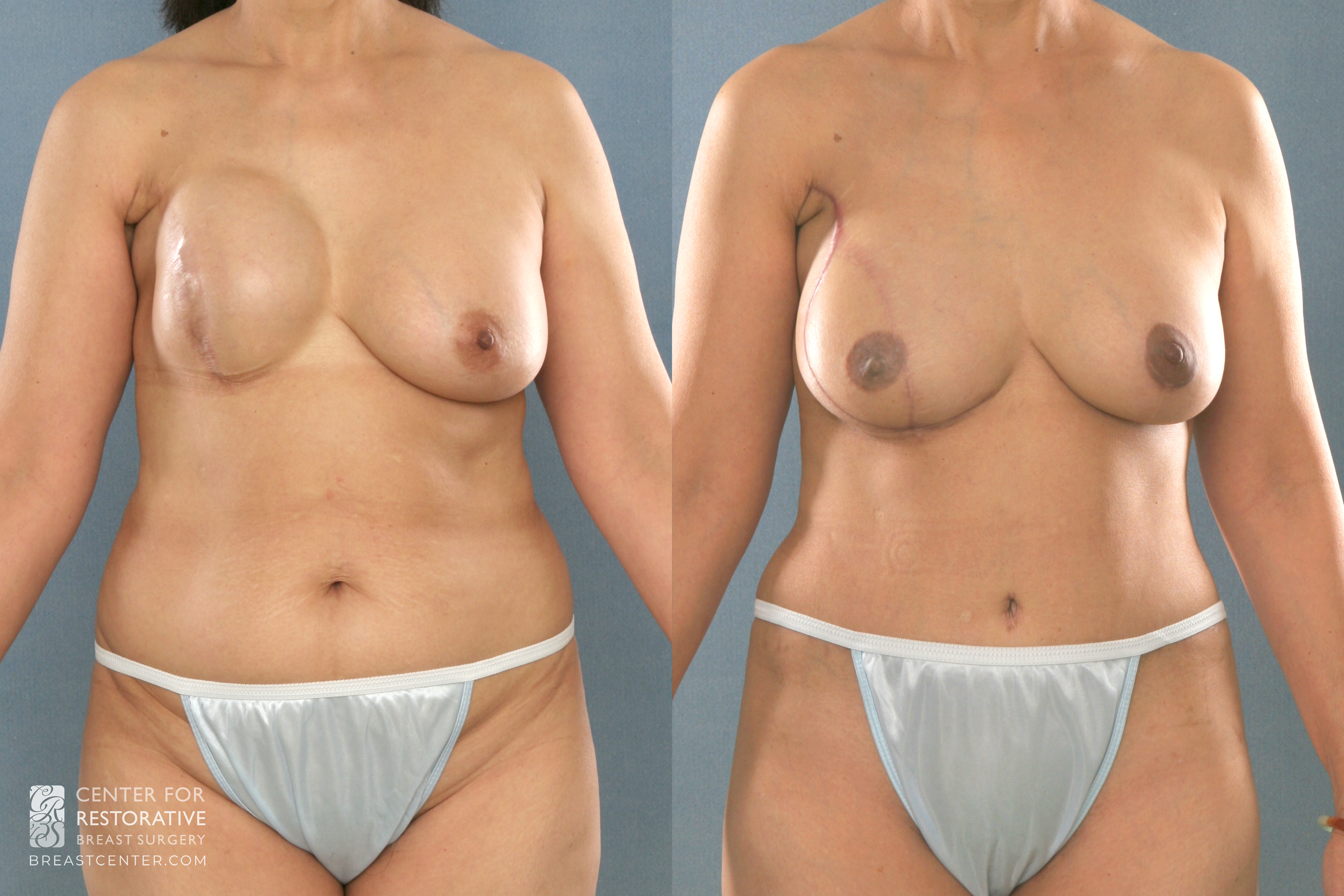 Before and after picture of breast reconstruction revision. Stacked DIEP flap reconstruction right breast and SIEA flap augmentation left breast for symmetry.