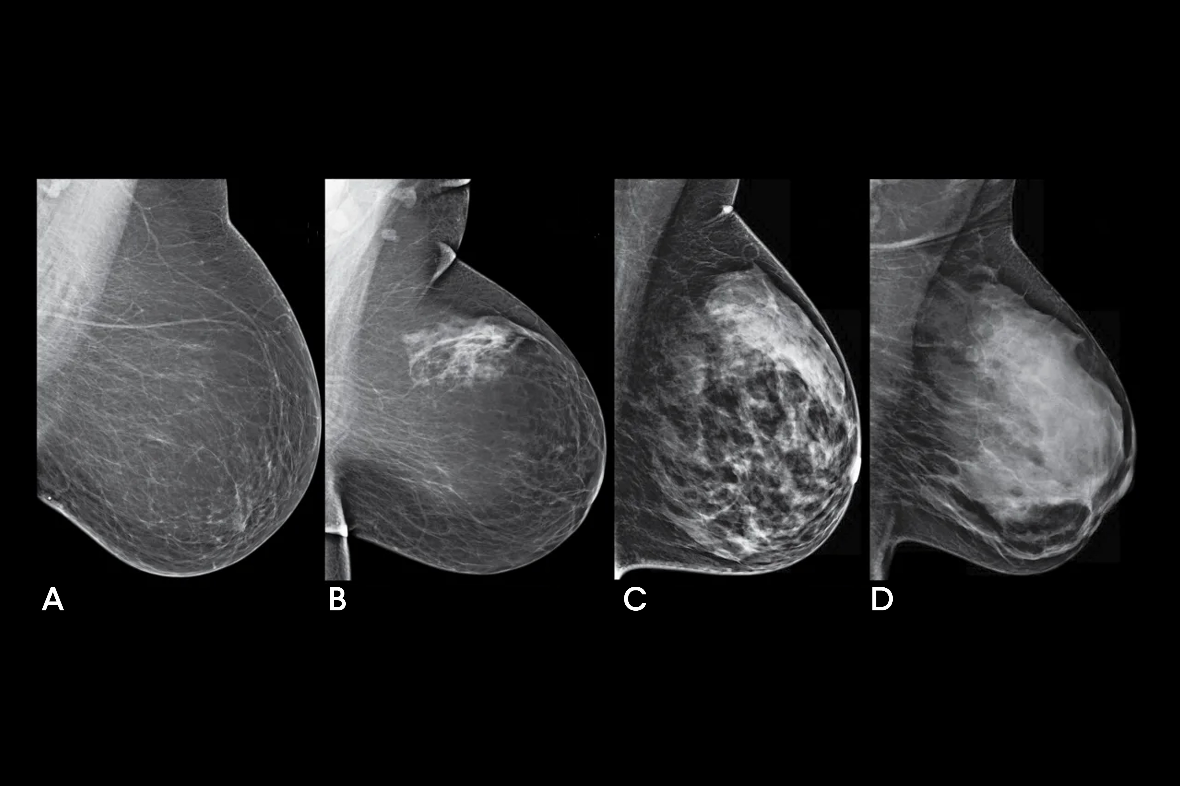 Different cases of breast (a) small breast (b) large breast (c