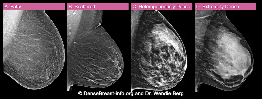 A comparison of four different mammogram images showing different breast densities