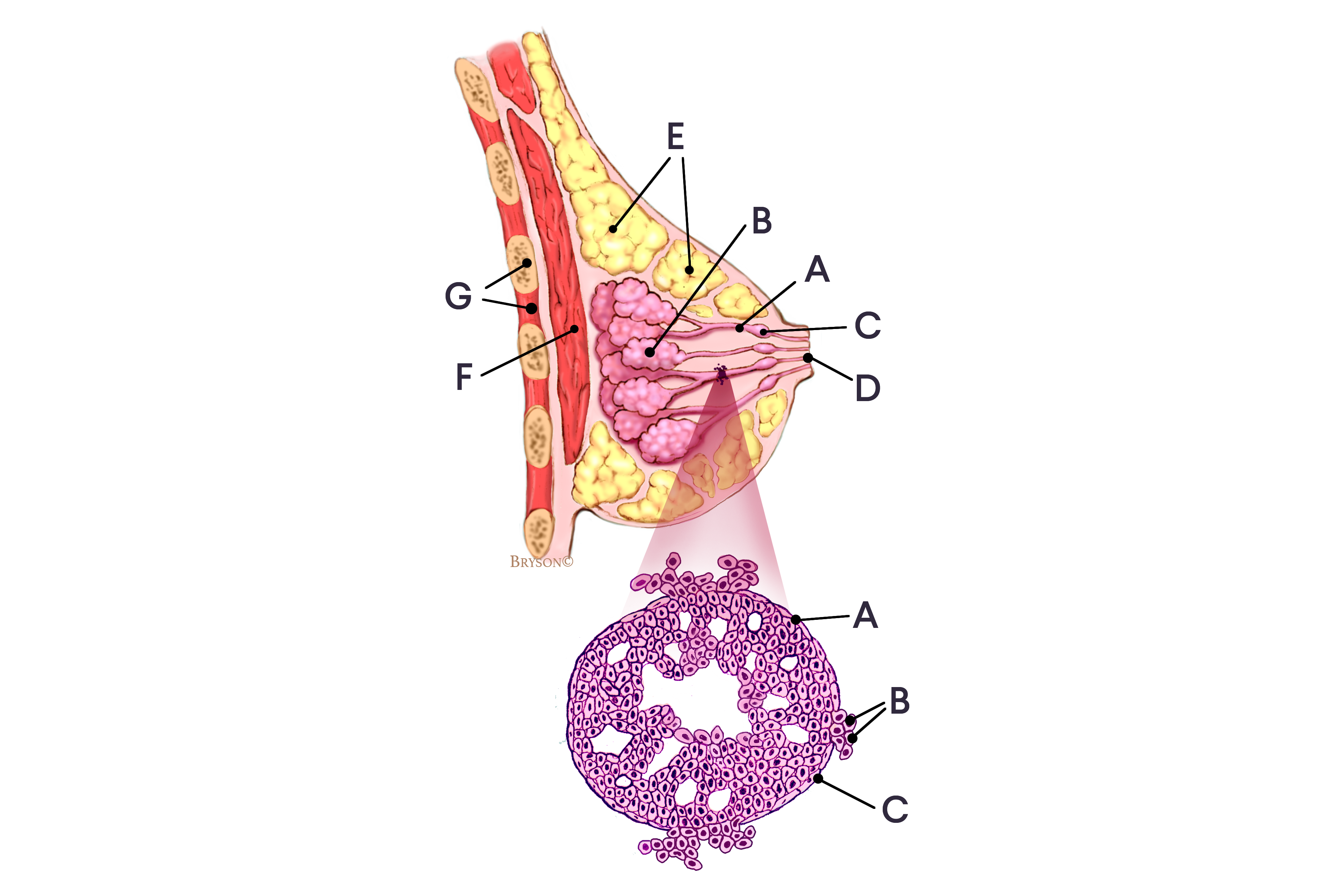 Invasive Ductal Carcinoma IDC Grade Symptoms Diagnosis